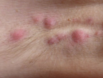 Pūlingas hidradenitas
