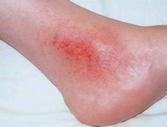 Stazinis dermatitas