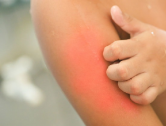 Alerginis kontaktinis dermatitas