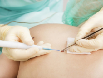 Melanomos gydymas