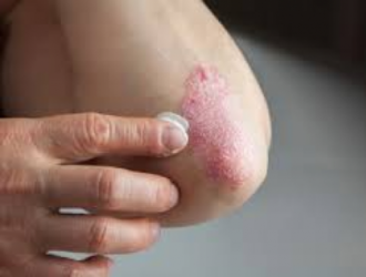 Skirtingų kūno sričių psoriazės gydymas
