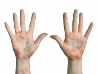 Psoriazės tipai