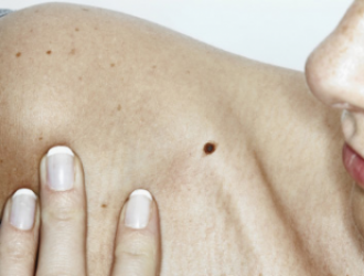 Skin cancer info