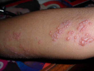 Herpes zoster infekcija arba juostinė pūslelinė