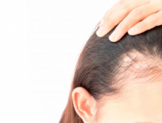 Moterų androgeninė alopecija