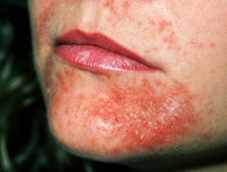 Perioralinis dermatitas