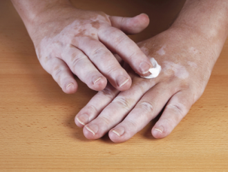 Vitiligo gydymas