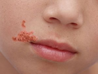 Impetiga