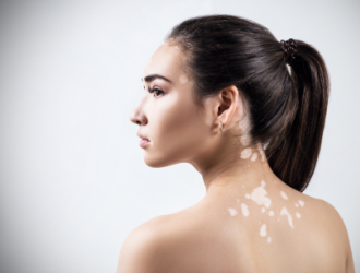 Odos priežiūros rekomendacijos sergant vitiligo