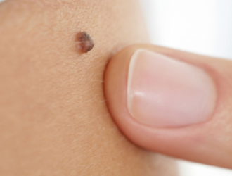 Melanoma