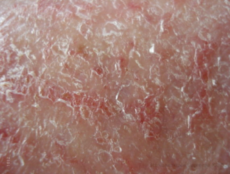 Sausos odos dermatitas