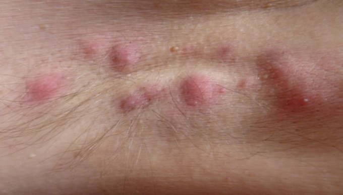 Pūlingas hidradenitas