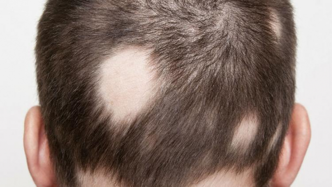 Židininė alopecija