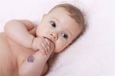 Kas yra hemangioma?