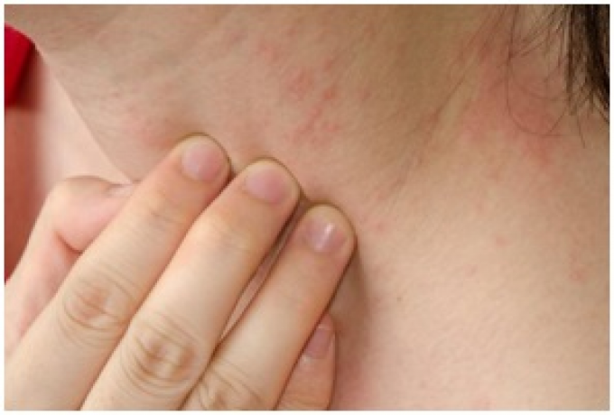 Atopinio dermatito diagnostika ir klasifikacija