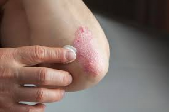 Skirtingų kūno sričių psoriazės gydymas