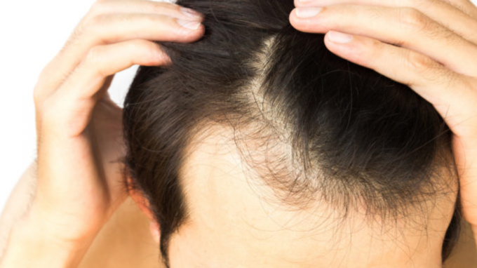 Vyrų androgeninė alopecija