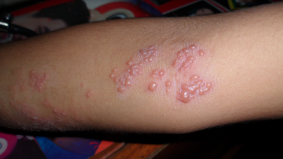 Herpes zoster infekcija arba juostinė pūslelinė