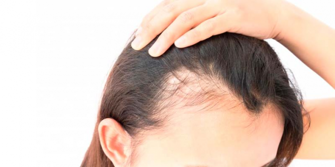 Moterų androgeninė alopecija