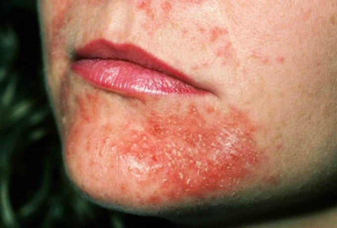 Perioralinis dermatitas