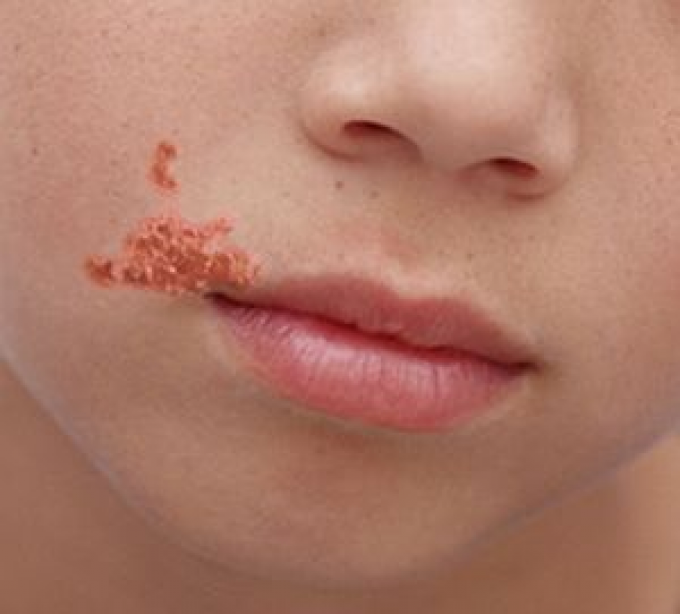 Impetiga