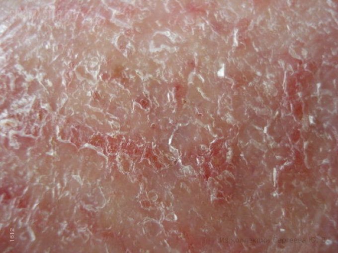 Sausos odos dermatitas